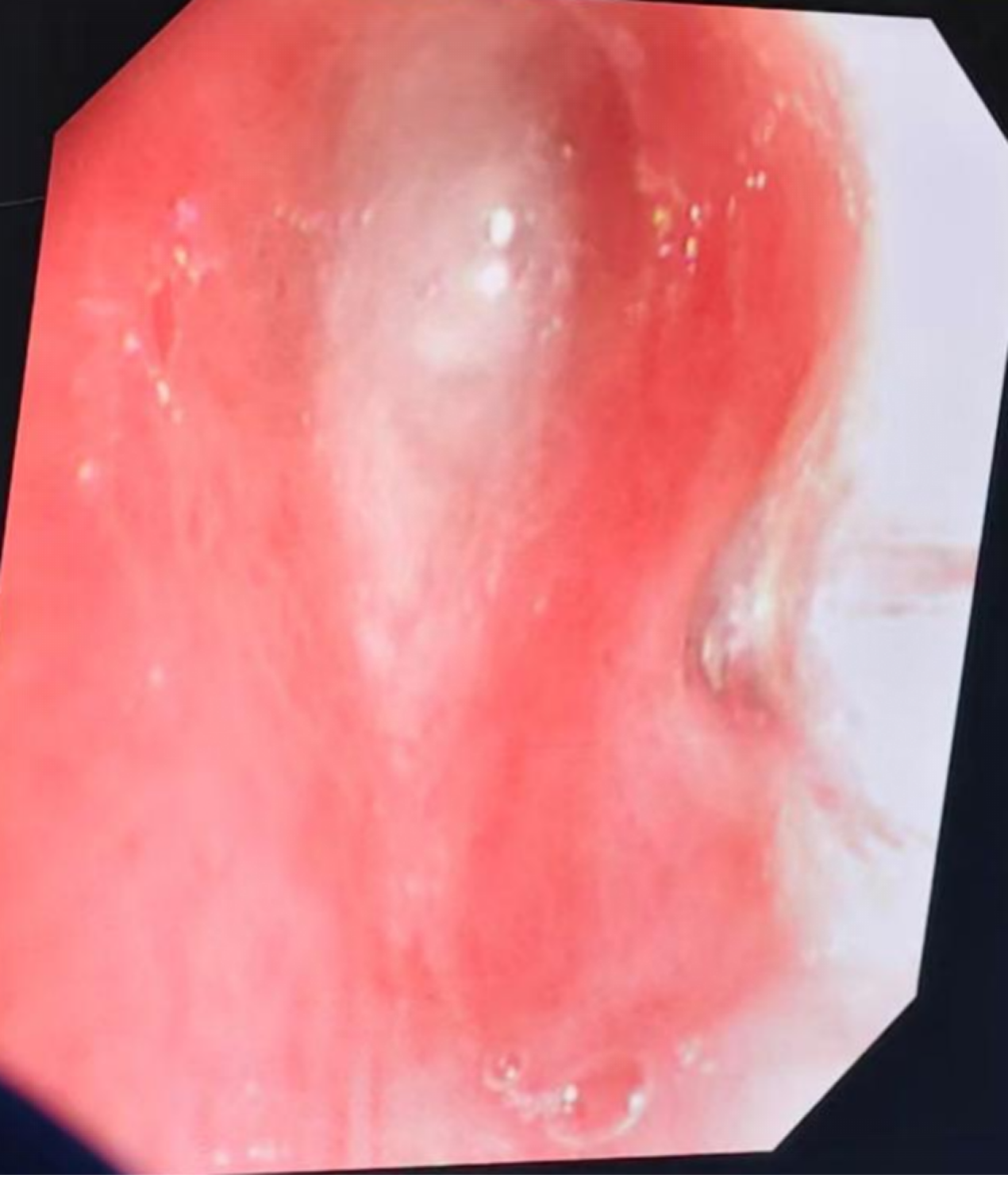 初中生发热 1 天肺全白!这种会堵死气道的病,别当普通感冒