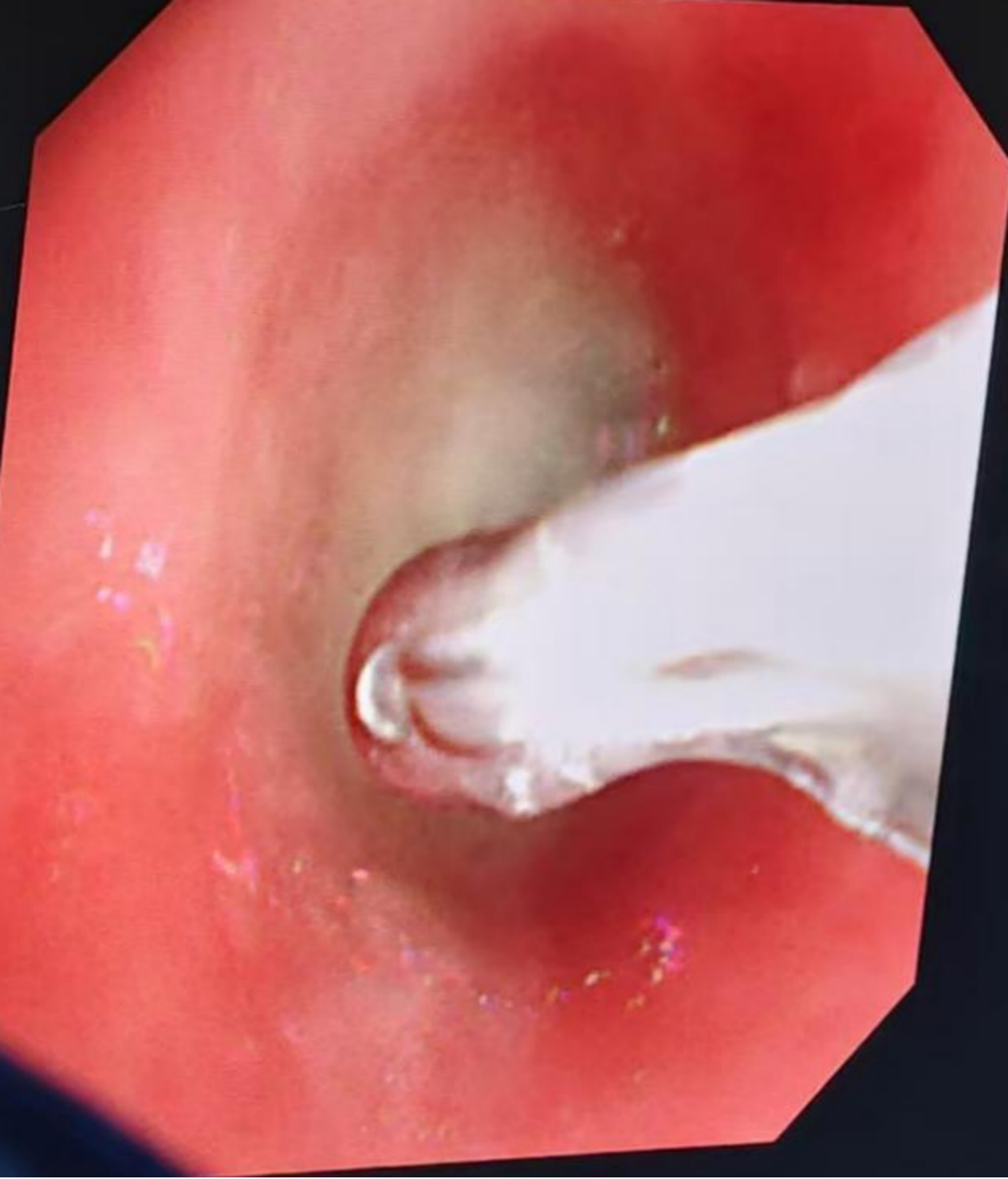 初中生发热 1 天肺全白!这种会堵死气道的病,别当普通感冒