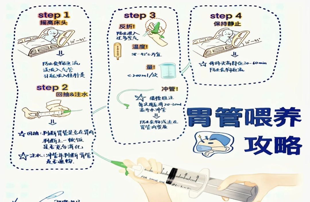 鼻饲管全程规范化护理：固定、喂养与并发症预防