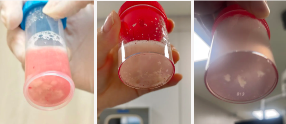 初中生发热 1 天肺全白!这种会堵死气道的病,别当普通感冒