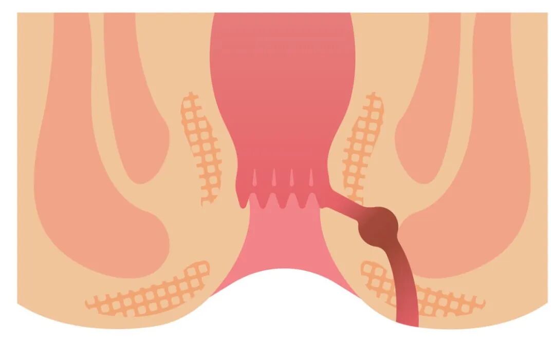 年纪轻轻，就去肛肠科「打卡」了？合肥京东方医院：大多是这几件事害的！