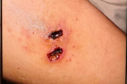 反复高烧 5 天！医生从 1 厘米结痂揪出元凶：这 3 类人的伤口不易愈合