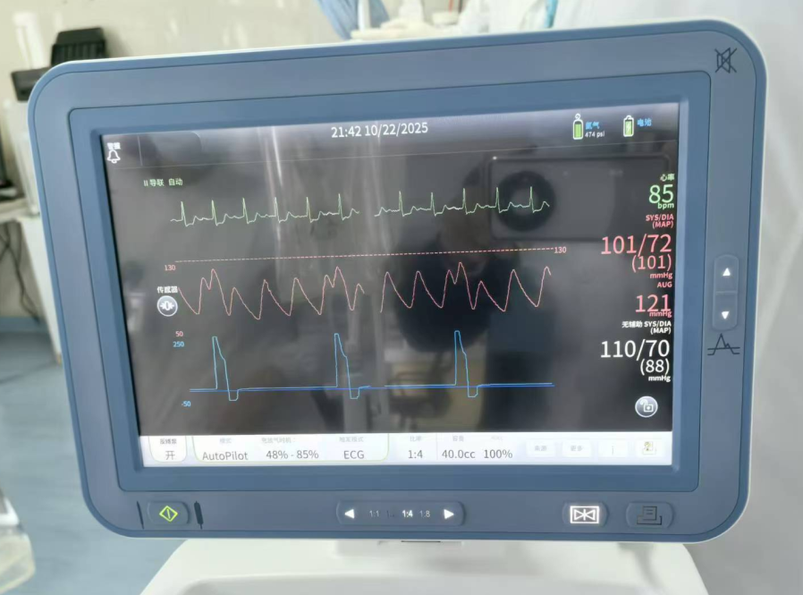 西安交大第一附属医院东院区开展首例主动脉内球囊反搏术(IABP)辅助下高危心肌梗死冠脉介入手术