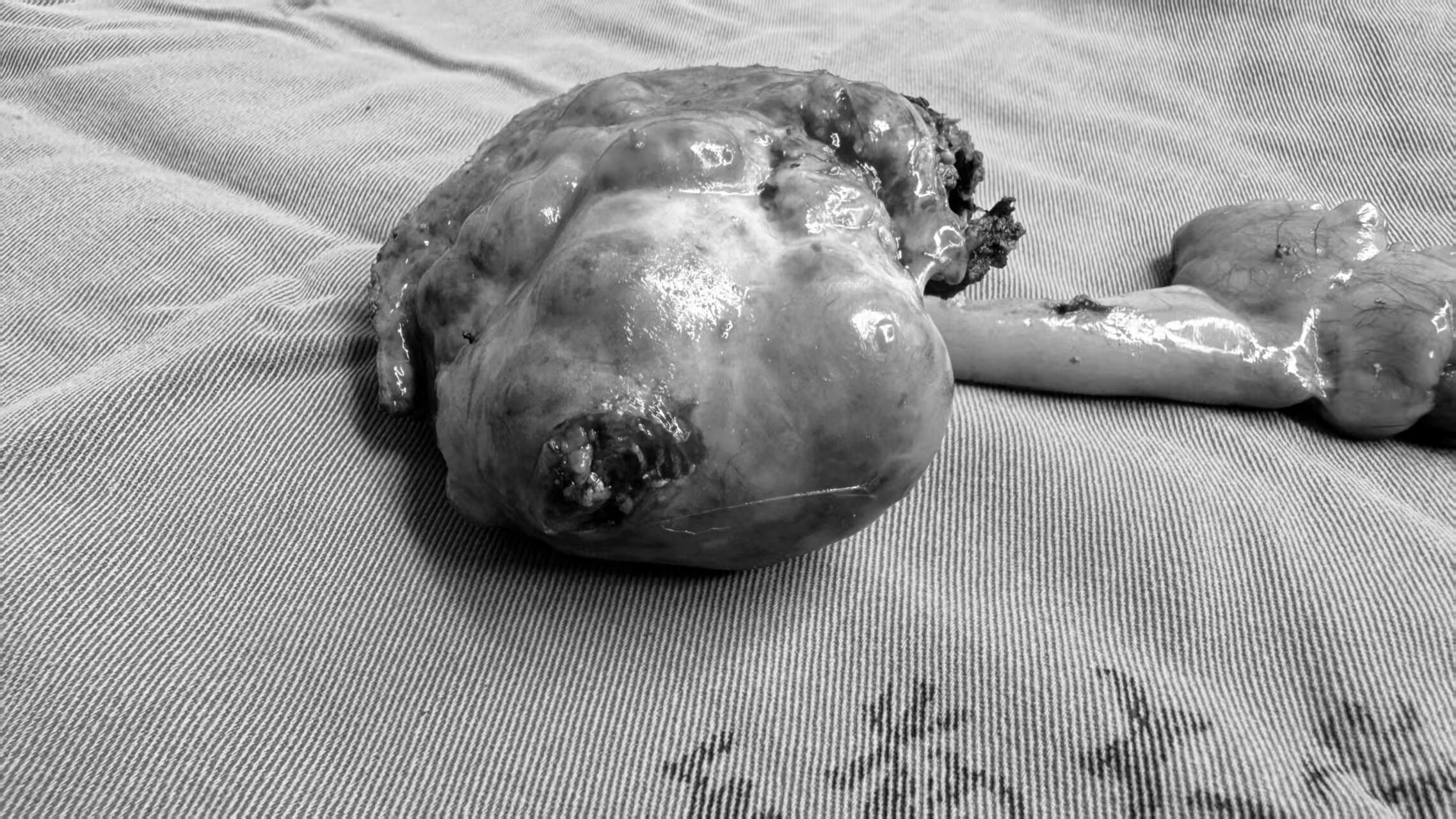 午夜 2 小时生死时速:肝癌破裂大出血,多学科团队联手「止血切瘤」化险为夷