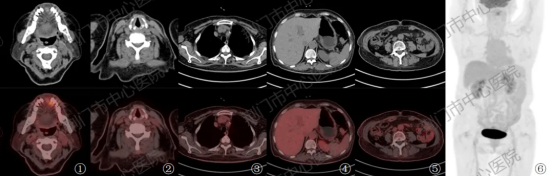 生命雷达精准「护航」抗癌路