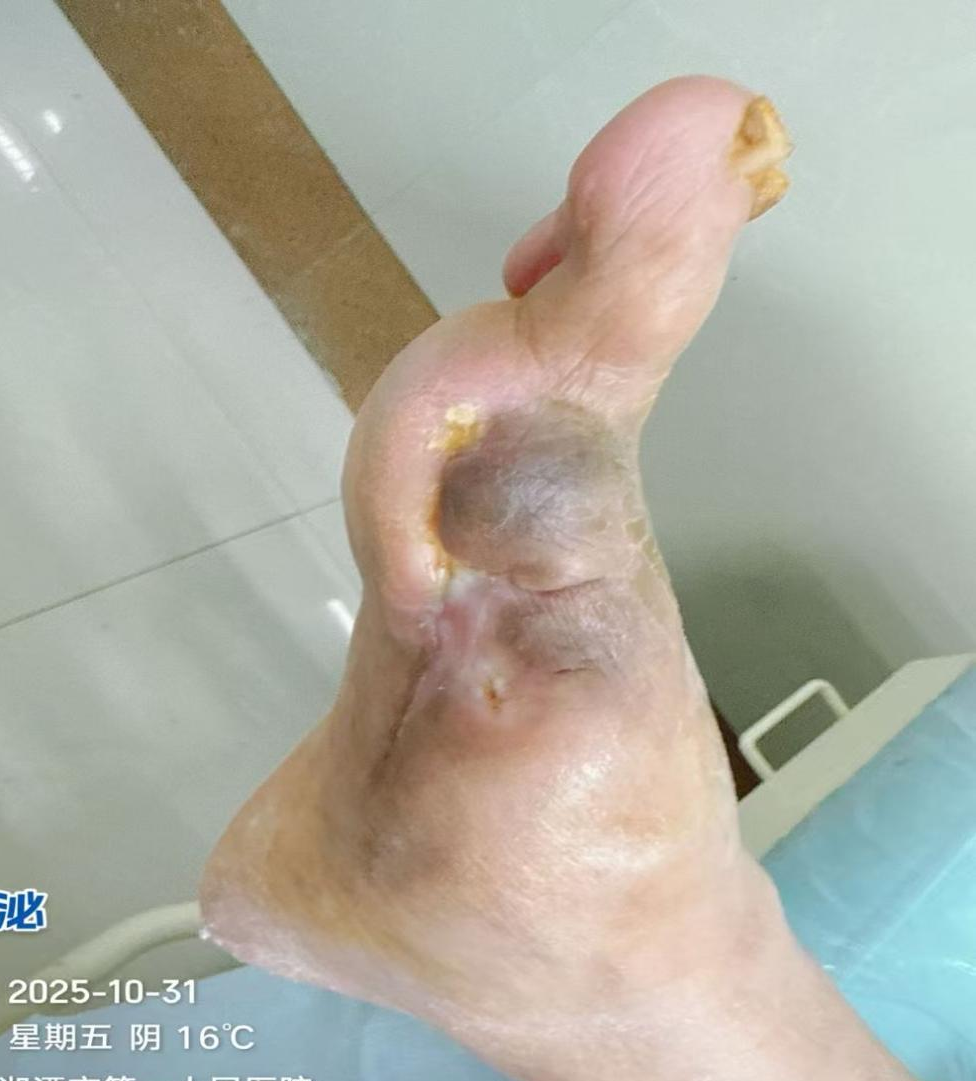 从「建议截肢」到成功保肢：湘潭市第一人民医院糖足团队精准守护患者行走权利