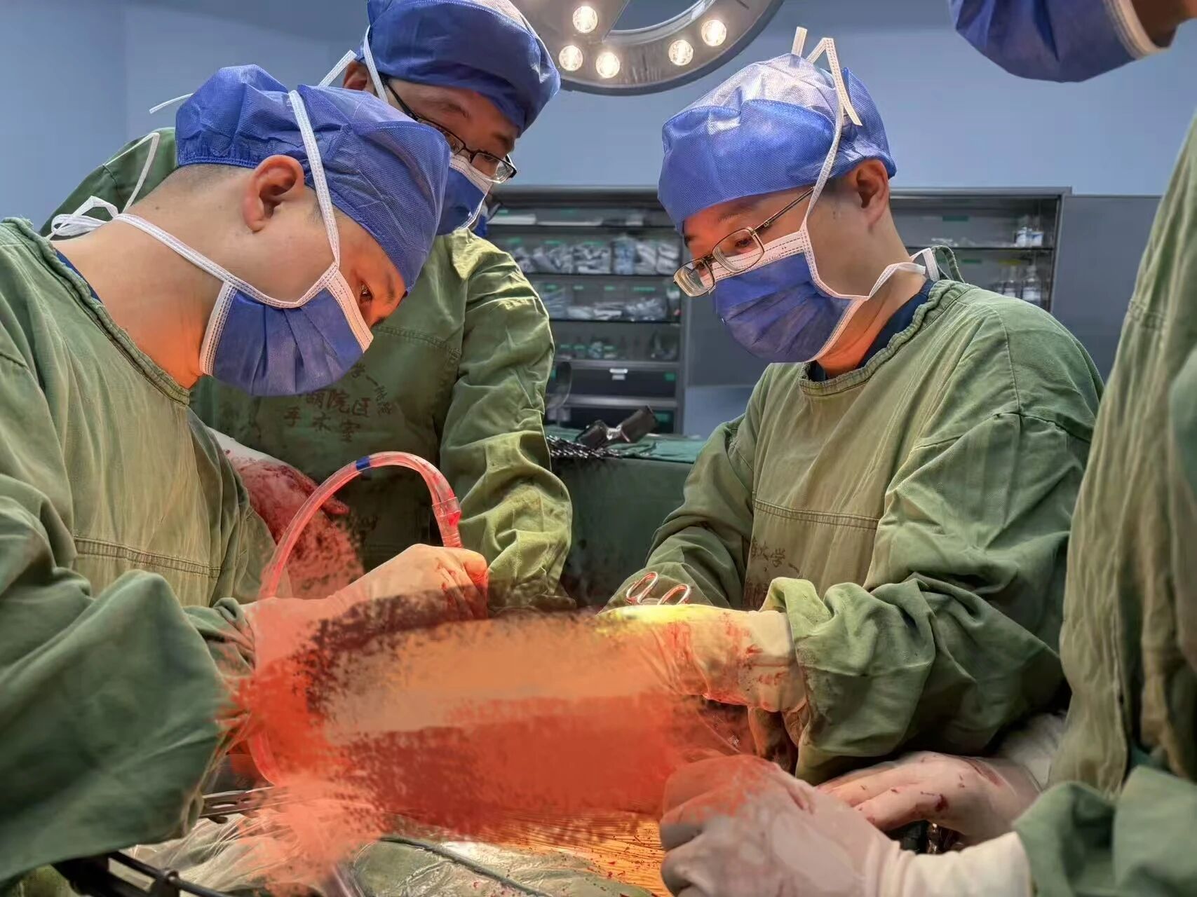 午夜 2 小时生死时速:肝癌破裂大出血,多学科团队联手「止血切瘤」化险为夷