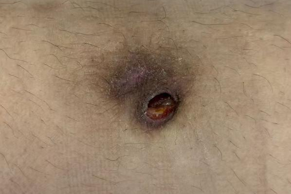 反复高烧 5 天！医生从 1 厘米结痂揪出元凶：这 3 类人的伤口不易愈合