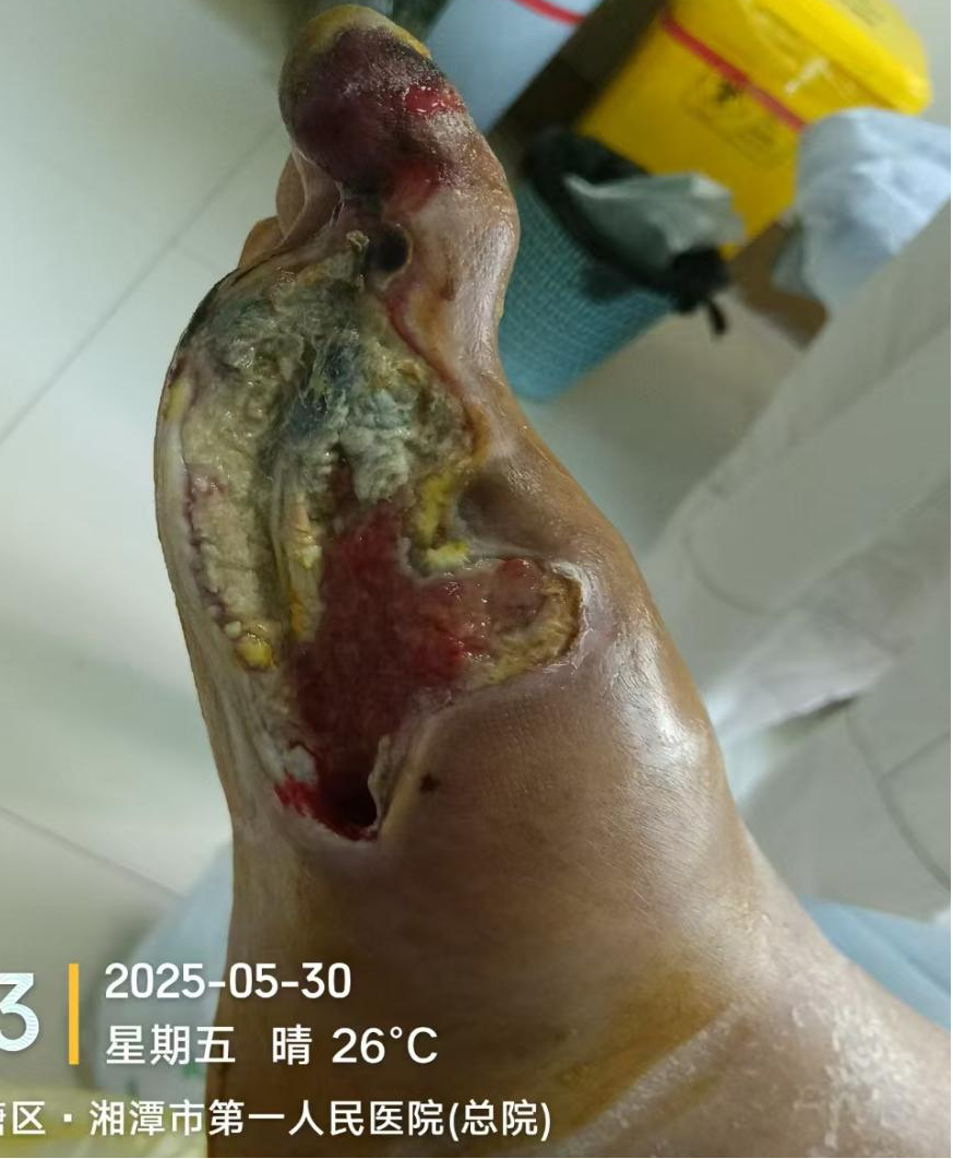 从「建议截肢」到成功保肢：湘潭市第一人民医院糖足团队精准守护患者行走权利