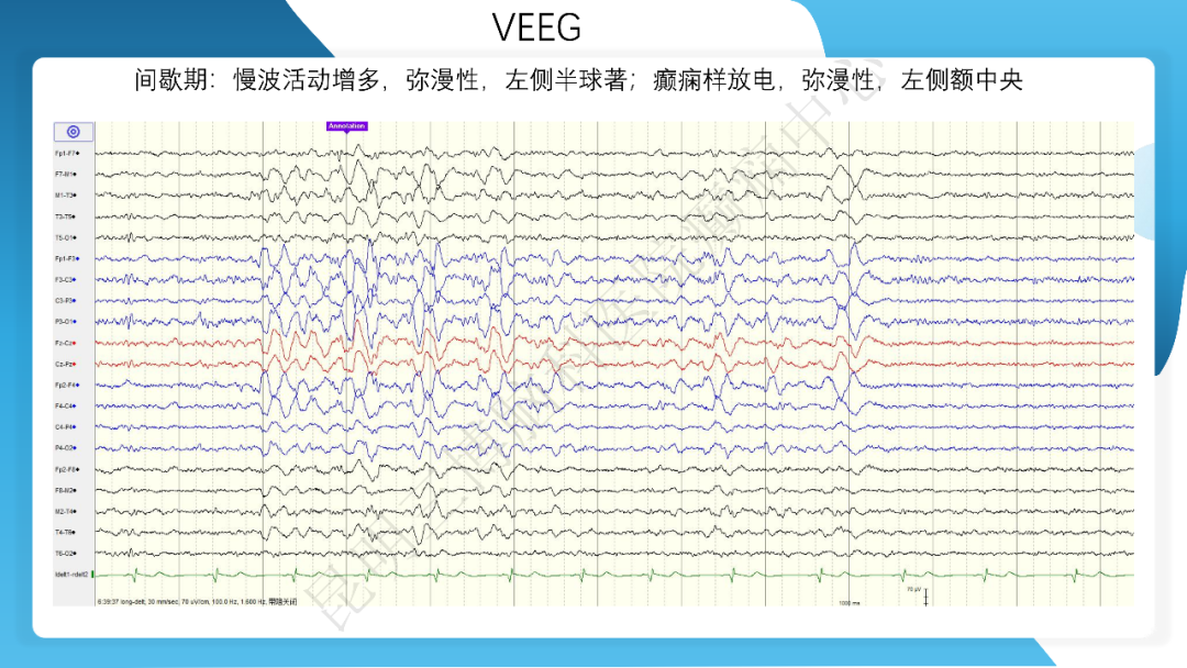 《「痫停」信步》癫痫治疗病例荟萃第三十五期---胼胝体全段切开治疗难治性癫痫 1 例