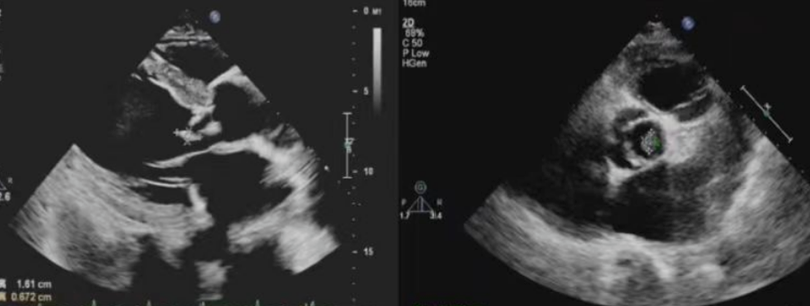 拔牙导致心脏犯病？当心「细菌刺客」