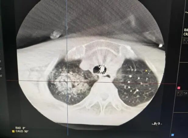 佛山市二医院绿岛湖院区成功开展佛山首例 AI 导航机器人辅助下经支气管肺结节冷冻消融术