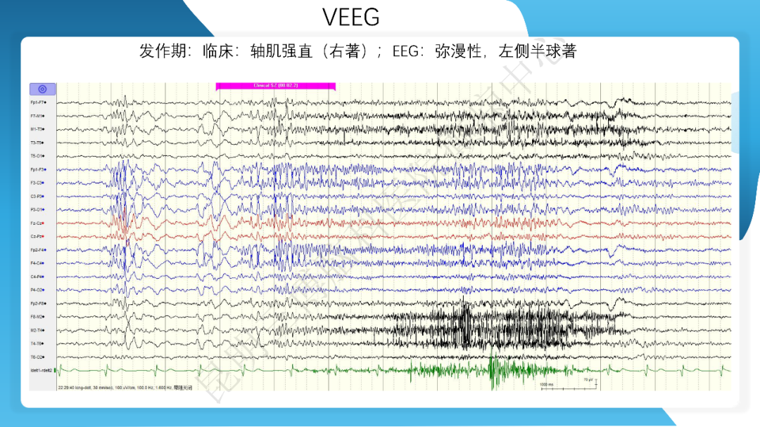 《「痫停」信步》癫痫治疗病例荟萃第三十五期---胼胝体全段切开治疗难治性癫痫 1 例