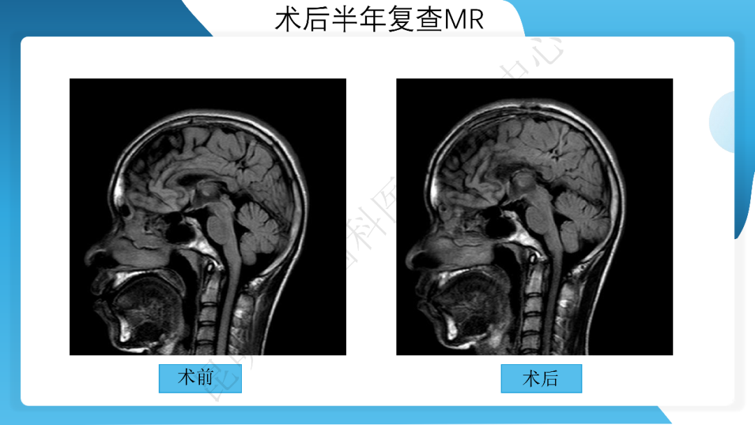 《「痫停」信步》癫痫治疗病例荟萃第三十五期---胼胝体全段切开治疗难治性癫痫 1 例