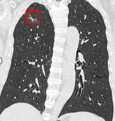 佛山市二医院绿岛湖院区成功开展佛山首例 AI 导航机器人辅助下经支气管肺结节冷冻消融术