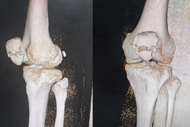 从一例髌骨骨折看老年人防摔与骨质疏松防治