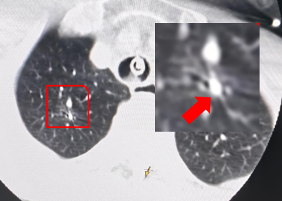 佛山市二医院绿岛湖院区成功开展佛山首例 AI 导航机器人辅助下经支气管肺结节冷冻消融术
