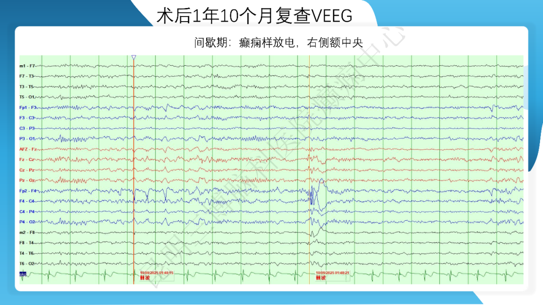 《「痫停」信步》癫痫治疗病例荟萃第三十五期---胼胝体全段切开治疗难治性癫痫 1 例