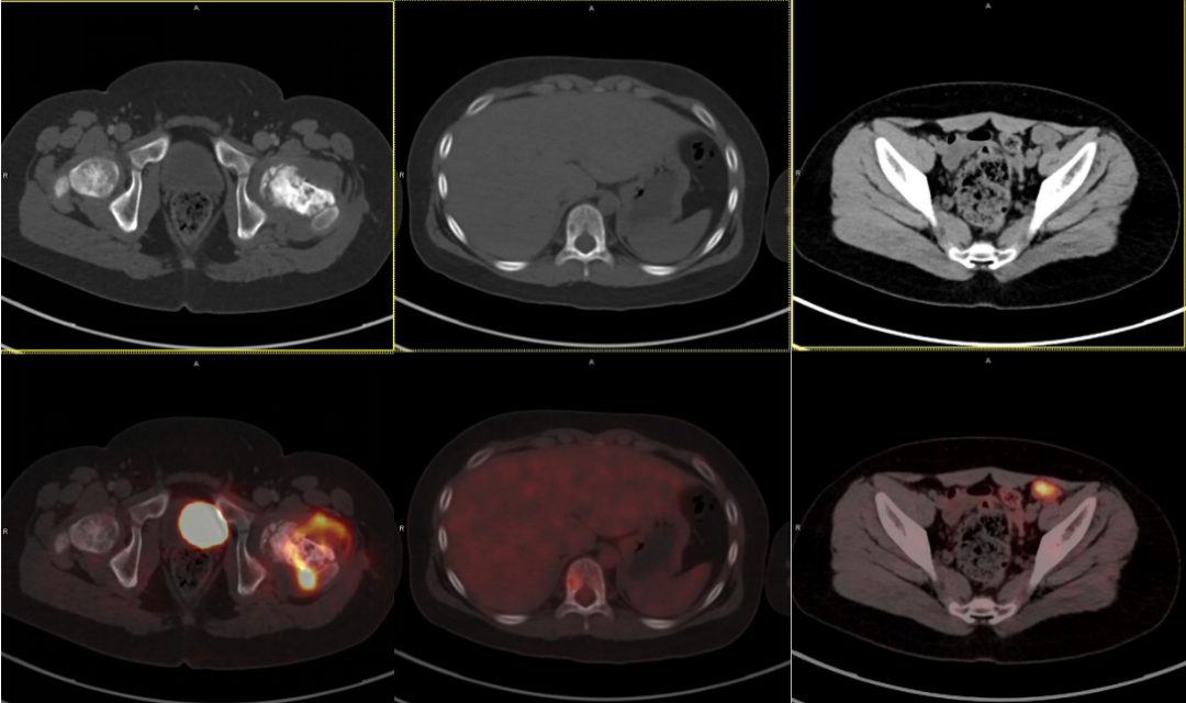从骨髓炎到肿瘤转移，一次 PET/CT 检查让 10 岁男孩的病情「全景浮现」