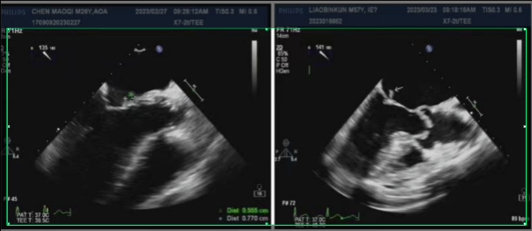 拔牙导致心脏犯病？当心「细菌刺客」