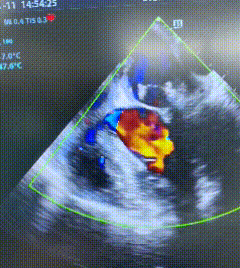 南京江北医院心脏大血管外科成功应用腱索转移技术，为六旬心衰患者保住「原装」心脏瓣膜