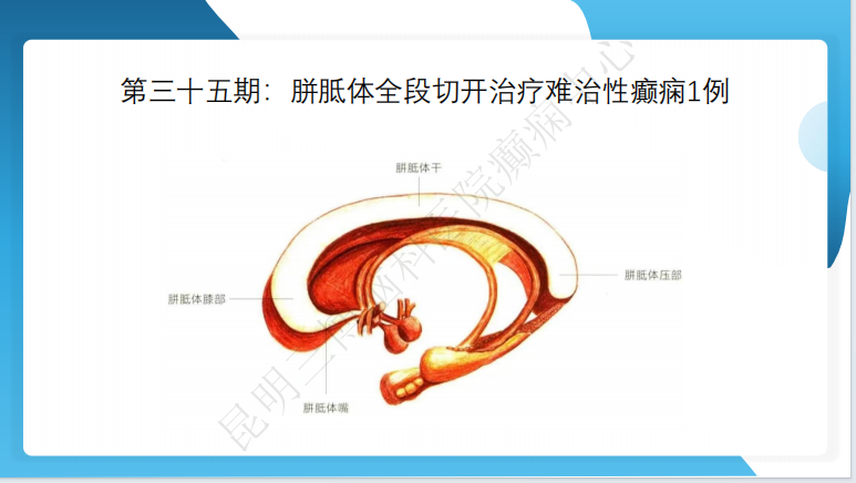 《「痫停」信步》癫痫治疗病例荟萃第三十五期---胼胝体全段切开治疗难治性癫痫 1 例