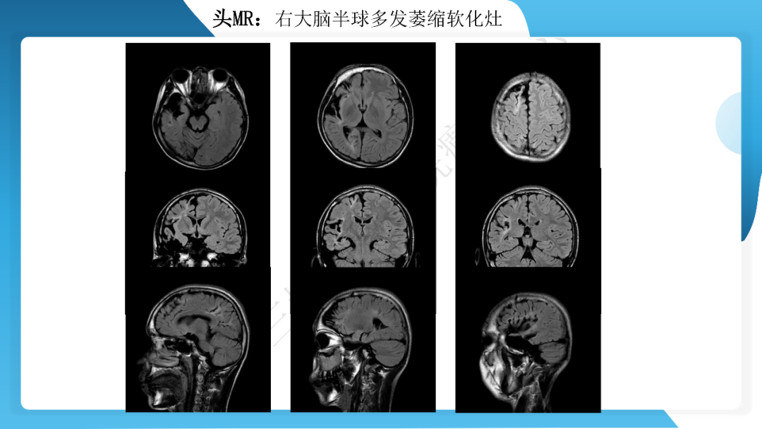 《「痫停」信步》癫痫治疗病例荟萃第三十五期---胼胝体全段切开治疗难治性癫痫 1 例