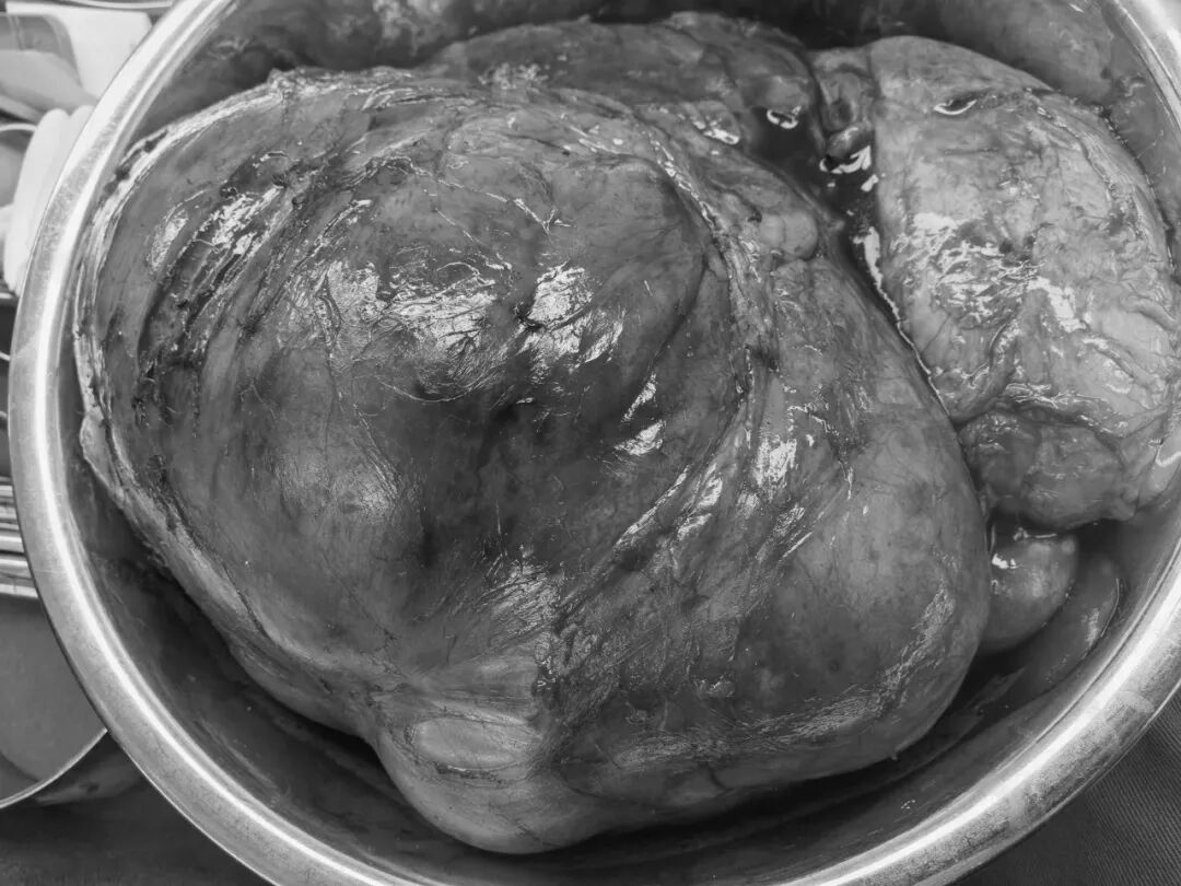 误把肿瘤当发福？漳州阿姨肚子鼓得不对称，一查竟是西瓜大的腹膜后肿瘤