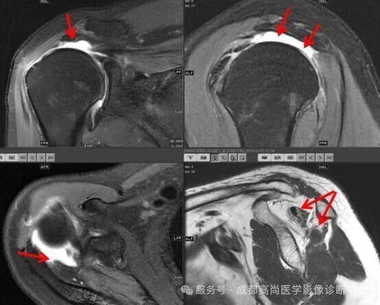 【高尚病例】MRI 右肩平扫诊断冈上肌腱断裂 1 例