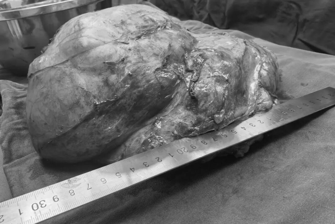 误把肿瘤当发福？漳州阿姨肚子鼓得不对称，一查竟是西瓜大的腹膜后肿瘤