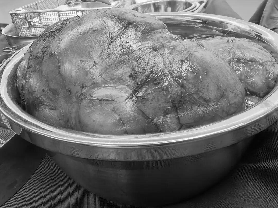 误把肿瘤当发福？漳州阿姨肚子鼓得不对称，一查竟是西瓜大的腹膜后肿瘤