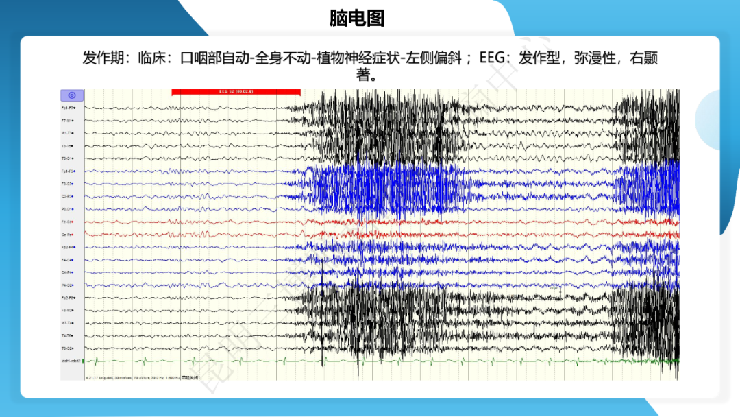 《「痫停」信步》癫痫治疗病例荟萃第三十七期---颞叶海绵状血管瘤相关癫痫的手术治疗一例