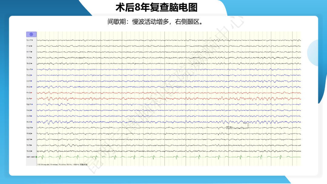 《「痫停」信步》癫痫治疗病例荟萃第三十七期---颞叶海绵状血管瘤相关癫痫的手术治疗一例