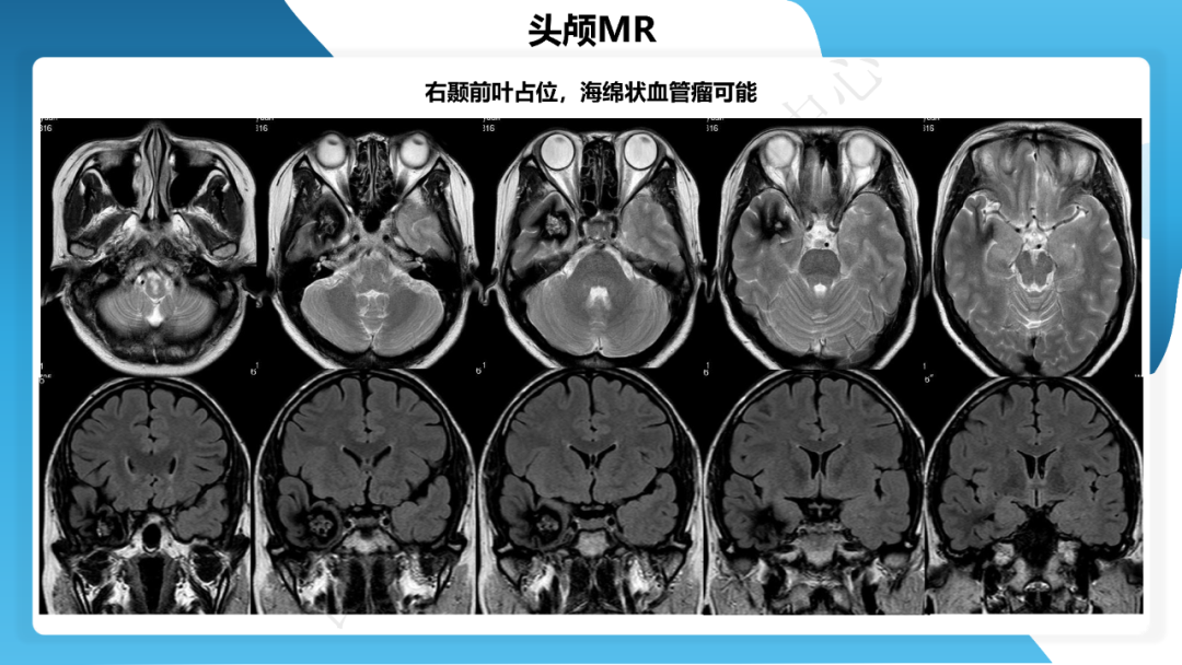 《「痫停」信步》癫痫治疗病例荟萃第三十七期---颞叶海绵状血管瘤相关癫痫的手术治疗一例