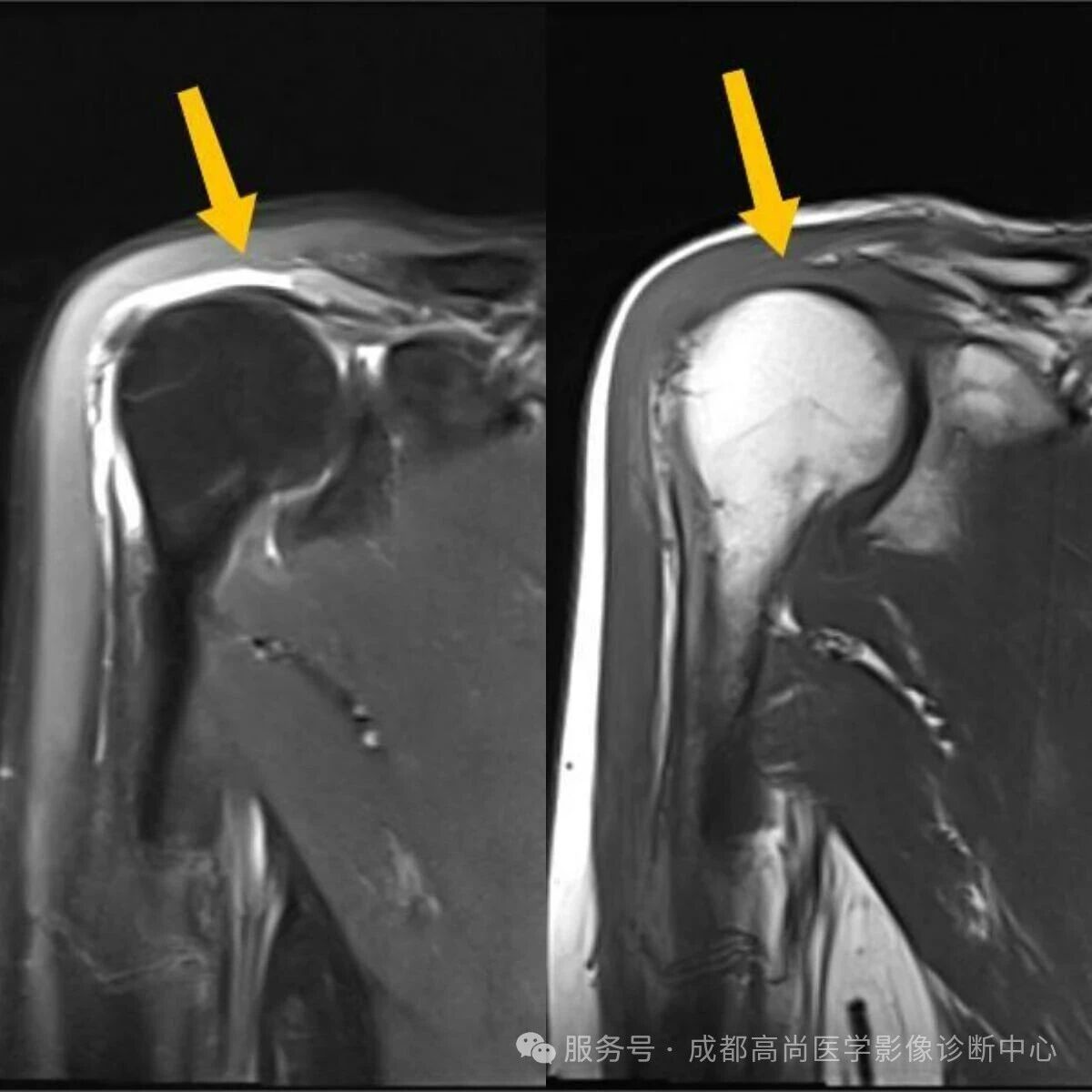 【高尚病例】MRI 右肩平扫诊断冈上肌腱断裂 1 例
