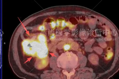【高尚病例】大便长期不成形，查出升结肠腺癌