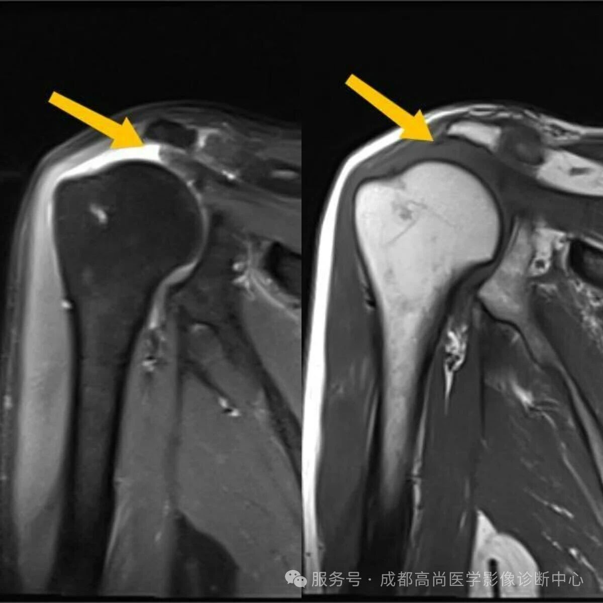 【高尚病例】MRI 右肩平扫诊断冈上肌腱断裂 1 例