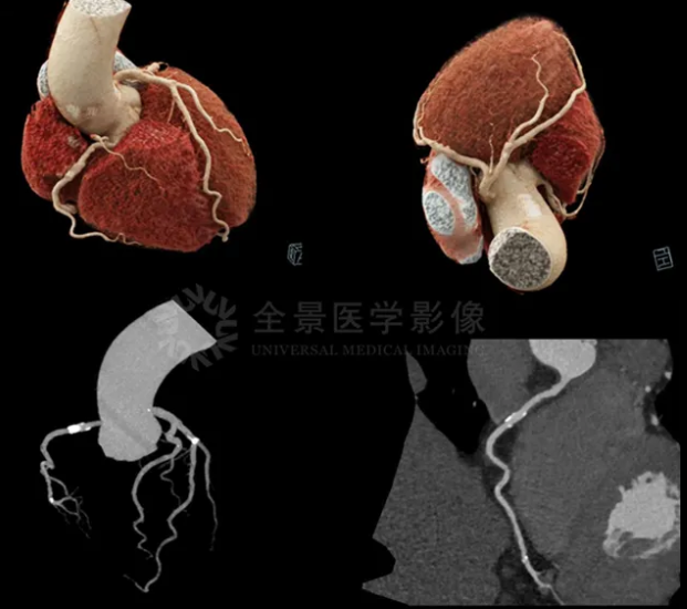 【冠脉 CTA+CT-FFR 检查】血管狭窄不严重≠心肌不缺血! - 医院汇 - 丁香园