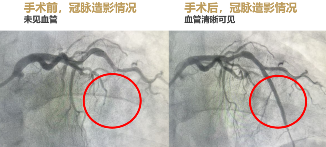 【检诊疗救助全纪实】血管 90%-100% 重度闭塞+易损斑块,如何化险为夷?