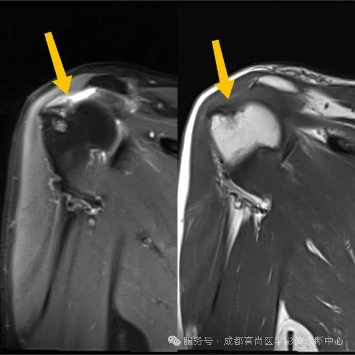 【高尚病例】MRI 右肩平扫诊断冈上肌腱断裂 1 例