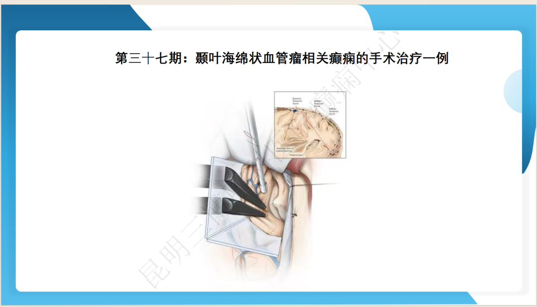 《「痫停」信步》癫痫治疗病例荟萃第三十七期---颞叶海绵状血管瘤相关癫痫的手术治疗一例