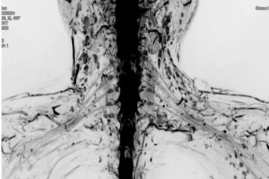 【高尚病例】臂丛神经的 MRI 扫描技术