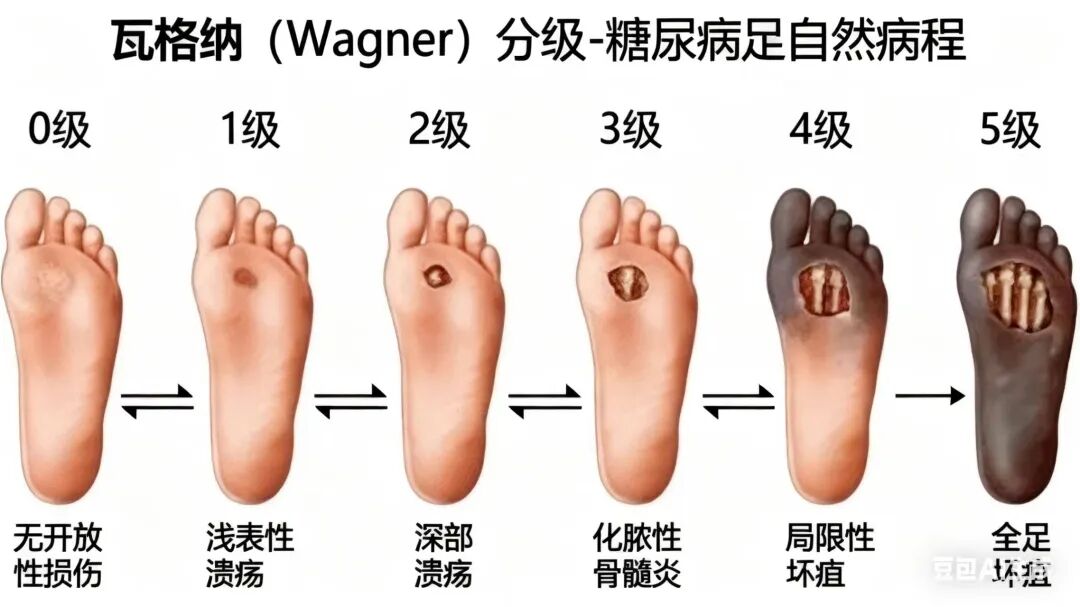 糖尿病足:从预防、诊治到多学科协作,别让「小伤口」酿成「大危机」
