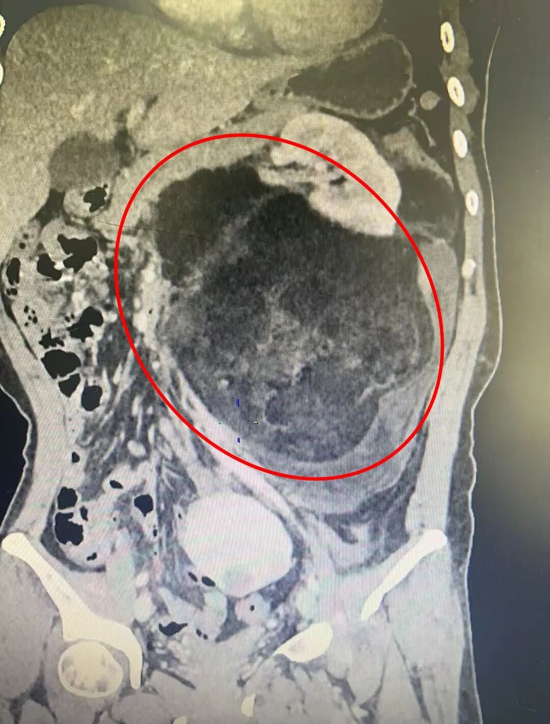 误把肿瘤当发福？漳州阿姨肚子鼓得不对称，一查竟是西瓜大的腹膜后肿瘤