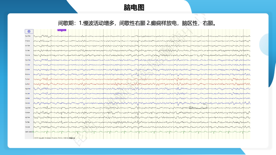 《「痫停」信步》癫痫治疗病例荟萃第三十七期---颞叶海绵状血管瘤相关癫痫的手术治疗一例
