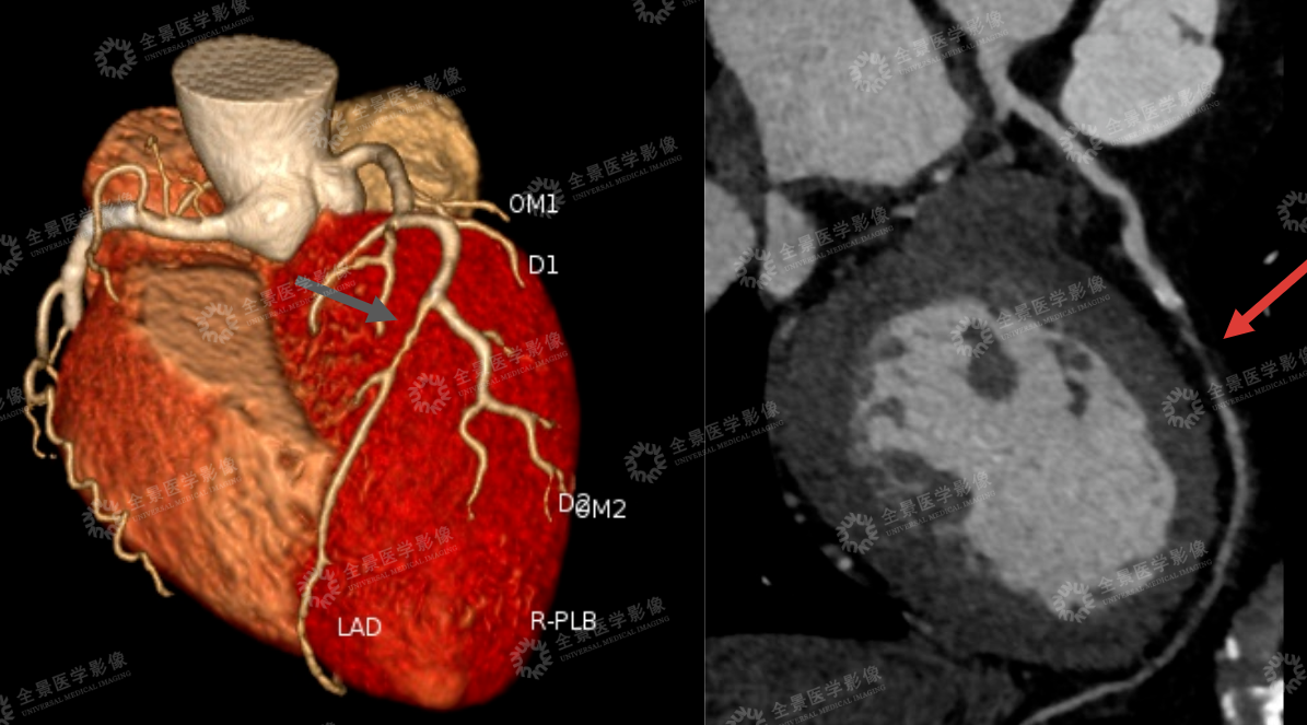 【检诊疗救助全纪实】血管 90%-100% 重度闭塞+易损斑块,如何化险为夷?