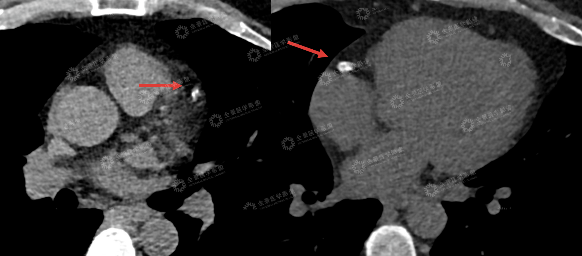 【检诊疗救助全纪实】血管 90%-100% 重度闭塞+易损斑块,如何化险为夷?
