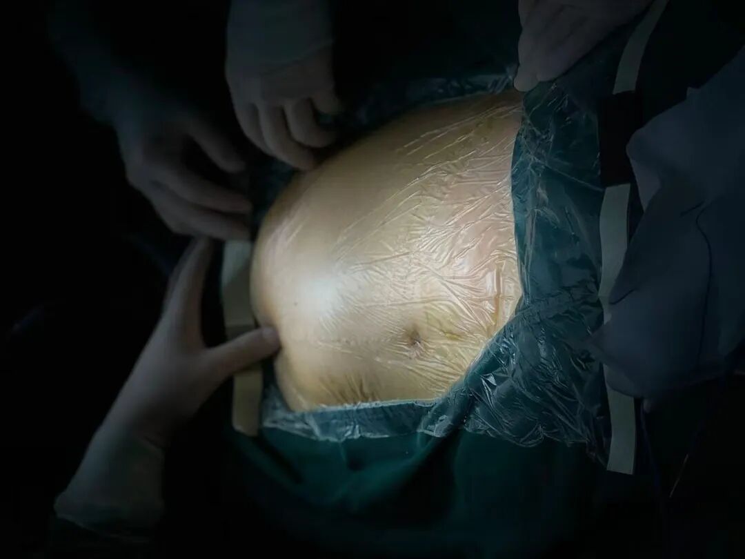 误把肿瘤当发福？漳州阿姨肚子鼓得不对称，一查竟是西瓜大的腹膜后肿瘤