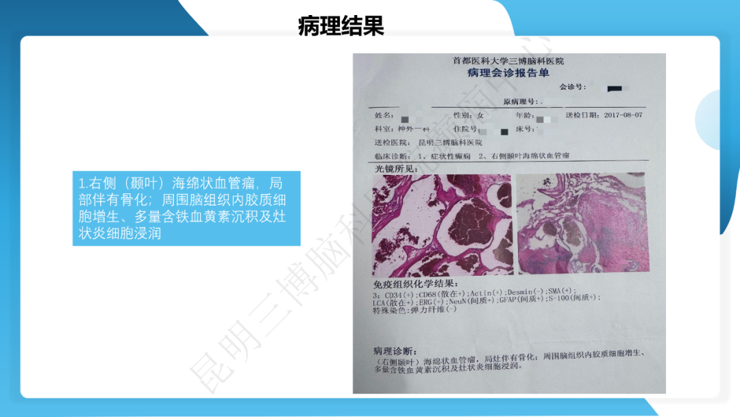 《「痫停」信步》癫痫治疗病例荟萃第三十七期---颞叶海绵状血管瘤相关癫痫的手术治疗一例