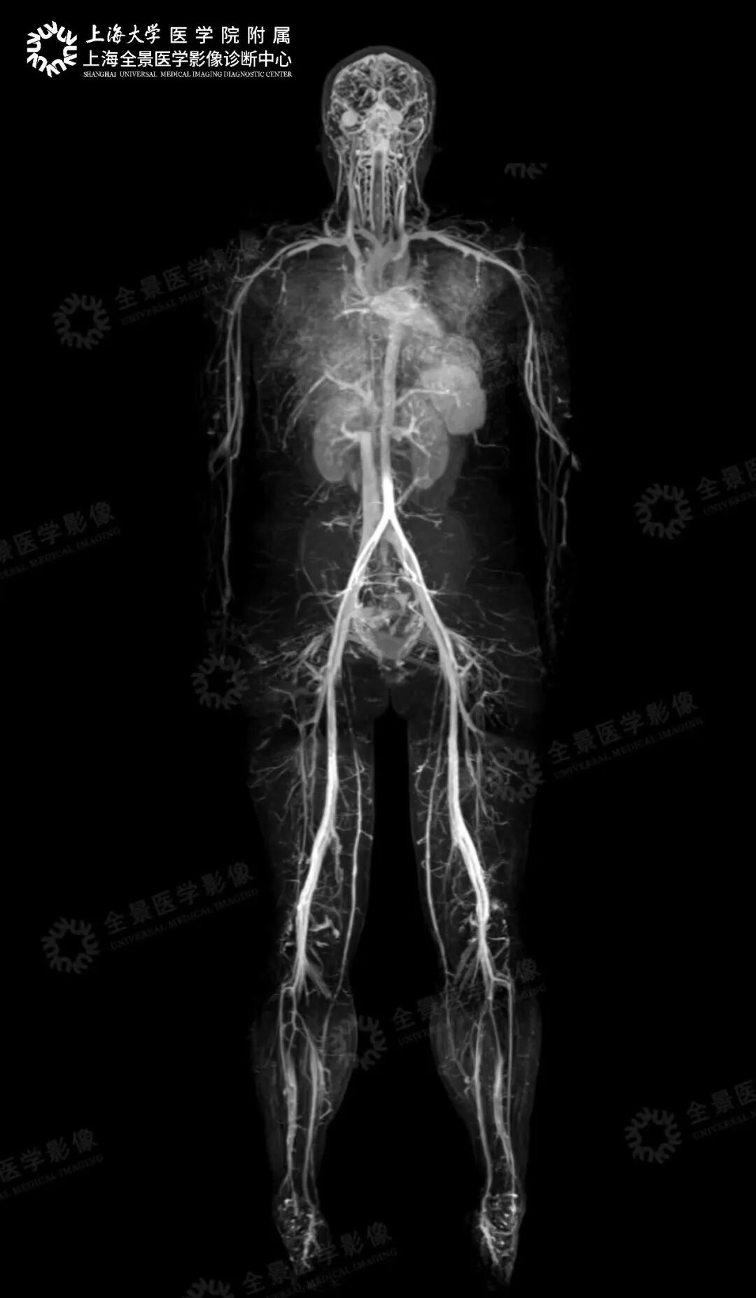 【检诊疗救助全纪实】血管 90%-100% 重度闭塞+易损斑块,如何化险为夷?